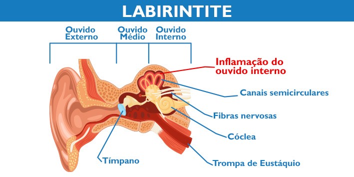 Labirintite o que e cid